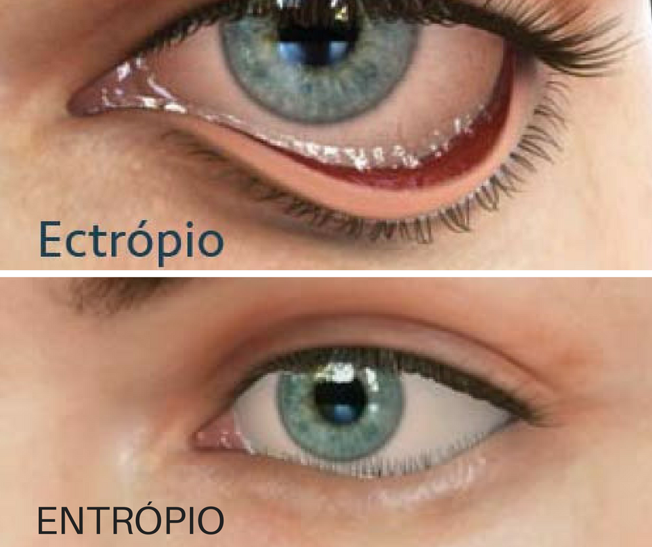 Ectrópio e entrópio: conheça esses distúrbios oftalmológicos