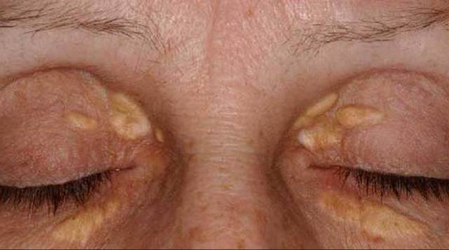 Xantelasma nos olhos: causas, sintomas e tratamentos